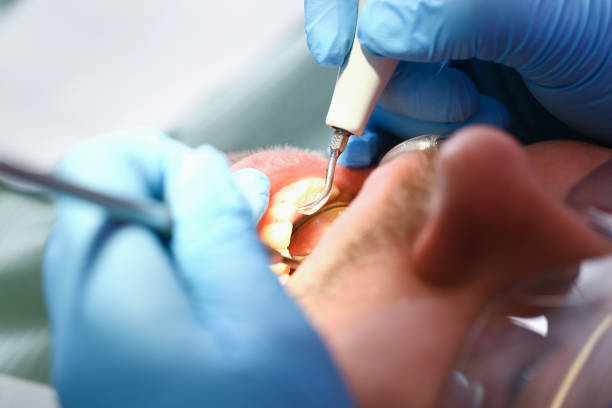 Best Emergency Root Canal Treatment in Felton, CA